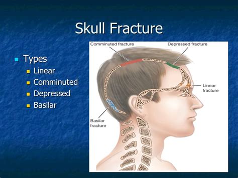 Basal skull fracture and the halo sign